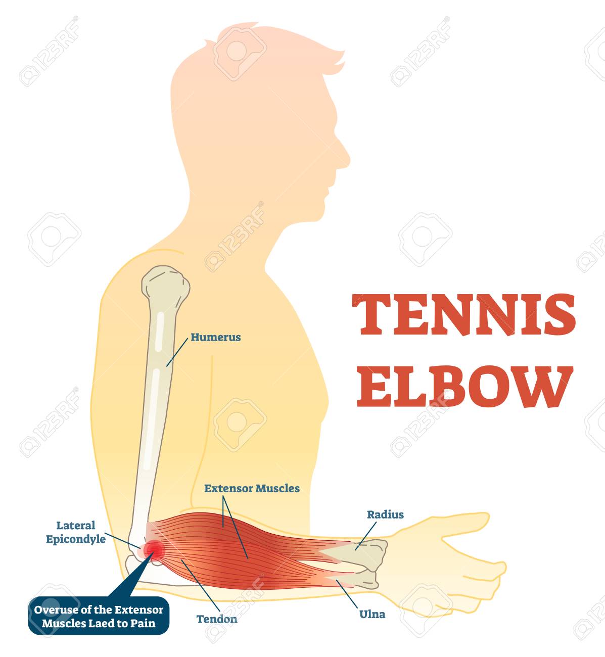 TennisElbow