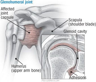 Frozen Shoulder