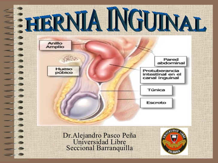 Hernia0